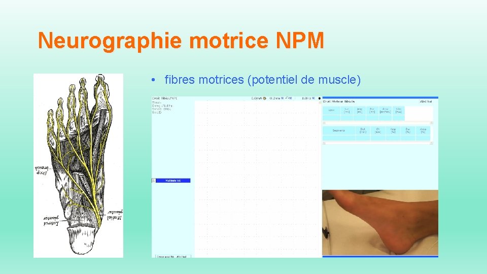 Neurographie motrice NPM • fibres motrices (potentiel de muscle) 