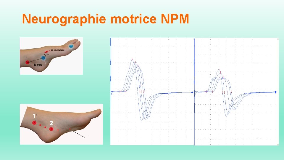 Neurographie motrice NPM 