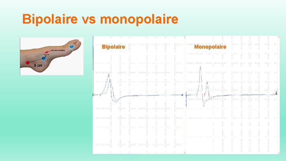 Bipolaire vs monopolaire Bipolaire Monopolaire 