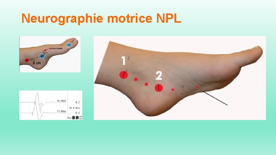 Neurographie motrice NPL 