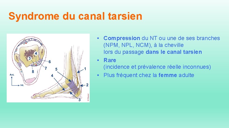 Syndrome du canal tarsien • Compression du NT ou une de ses branches (NPM,