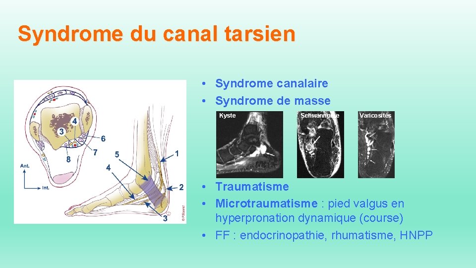 Syndrome du canal tarsien • Syndrome canalaire • Syndrome de masse Kyste Schwannome Varicosités