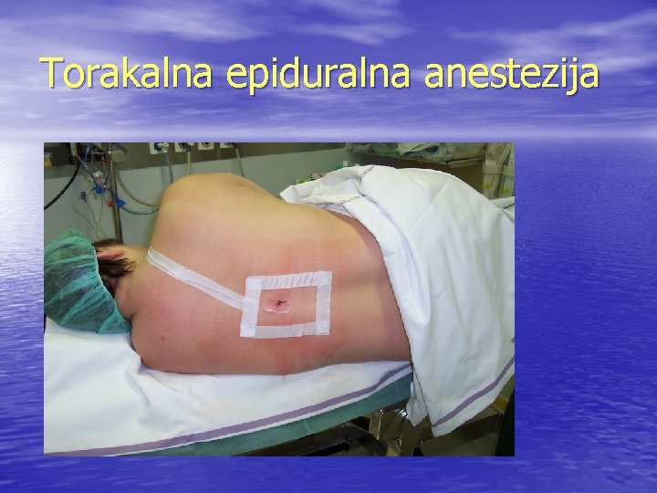 Torakalna epiduralna anestezija 