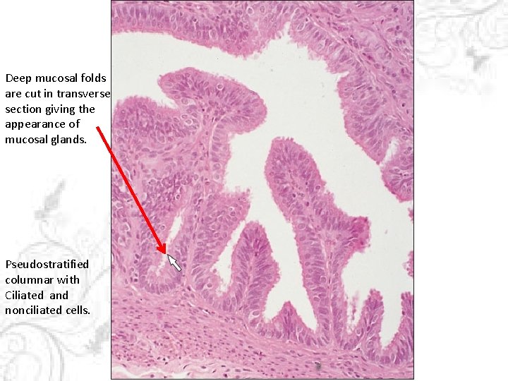 Deep mucosal folds are cut in transverse section giving the appearance of mucosal glands.