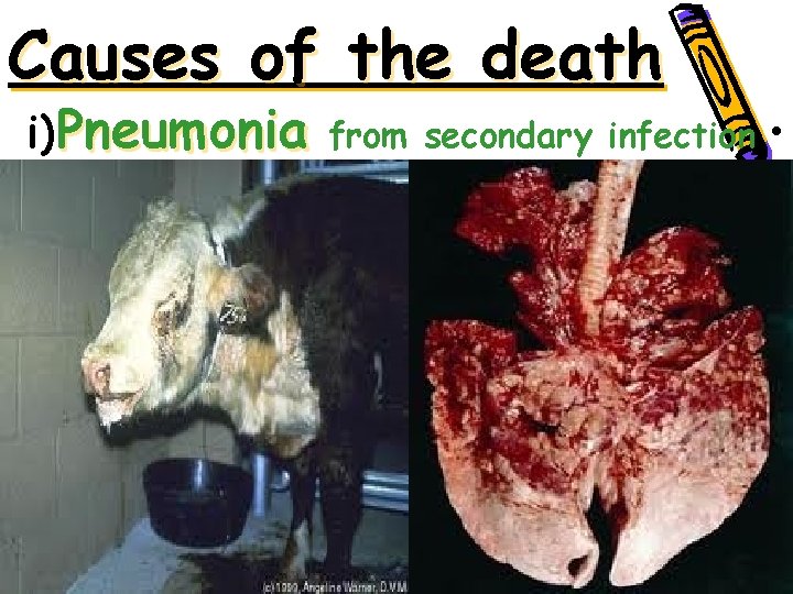 Causes of the death i)Pneumonia from secondary infection • 