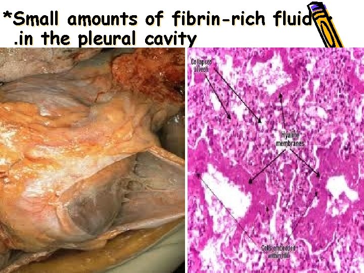*Small amounts of fibrin-rich fluid • . in the pleural cavity • 