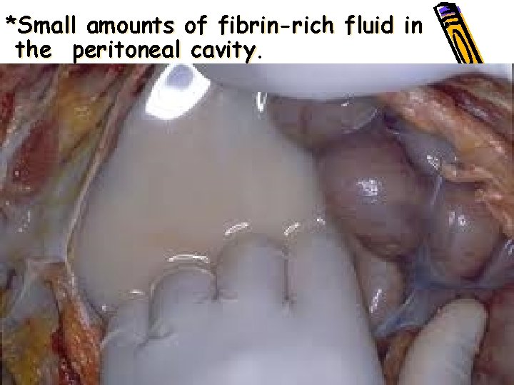 *Small amounts of fibrin-rich fluid in • the peritoneal cavity. • 