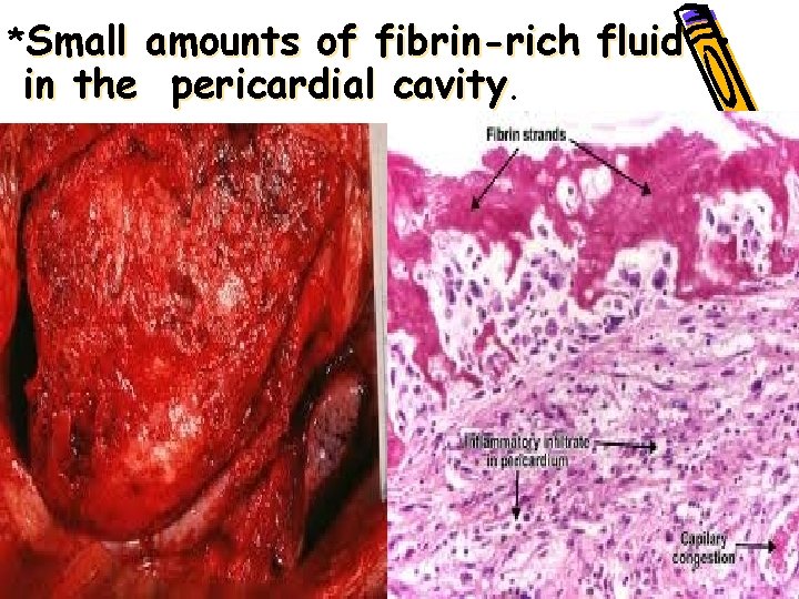 *Small amounts of fibrin-rich fluid • in the pericardial cavity. • 