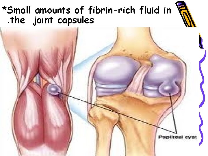 *Small amounts of fibrin-rich fluid in • . the joint capsules • 
