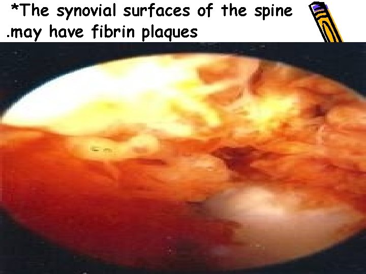 *The synovial surfaces of the spine. may have fibrin plaques • 