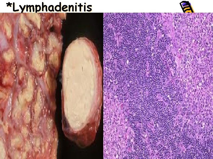 *Lymphadenitis • 