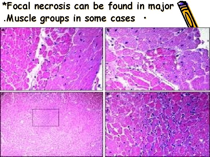 *Focal necrosis can be found in major • . Muscle groups in some cases