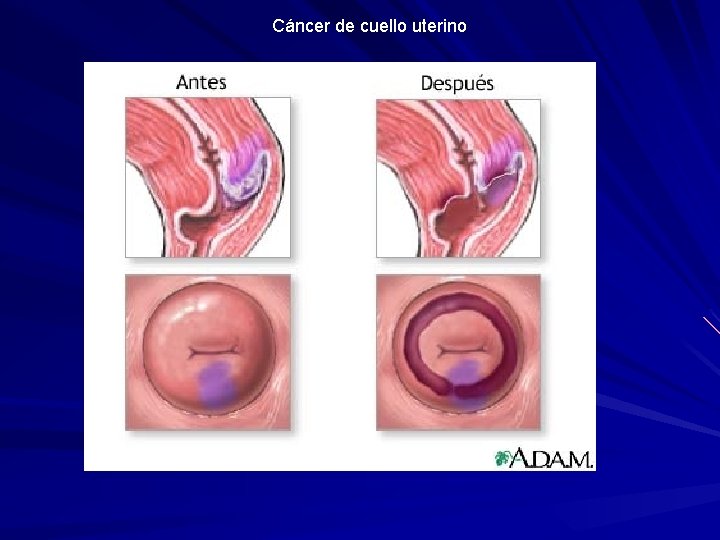 Cáncer de cuello uterino 