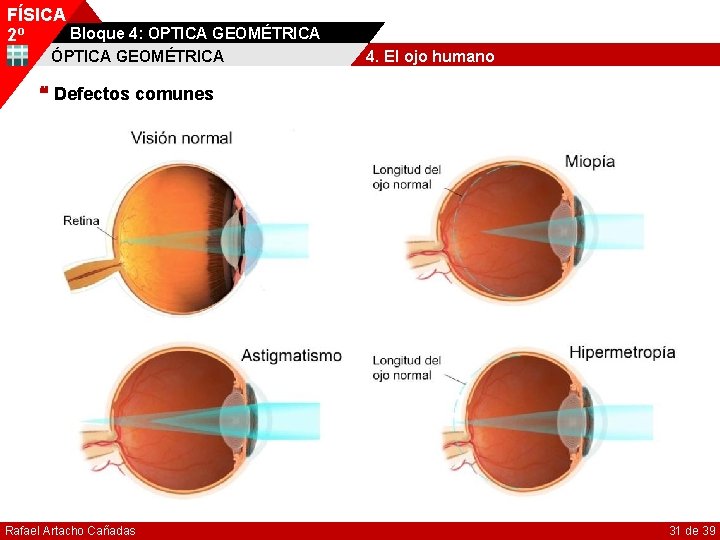 FÍSICA Bloque 4: OPTICA GEOMÉTRICA 2º ÓPTICA GEOMÉTRICA 4. El ojo humano Defectos comunes