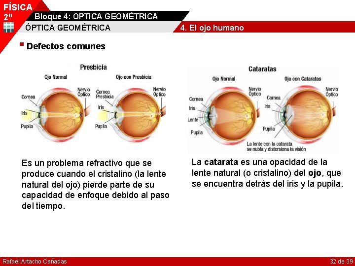 FÍSICA Bloque 4: OPTICA GEOMÉTRICA 2º ÓPTICA GEOMÉTRICA 4. El ojo humano Defectos comunes