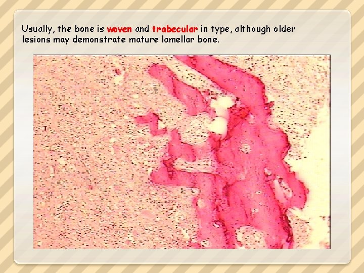 Usually, the bone is woven and trabecular in type, although older lesions may demonstrate