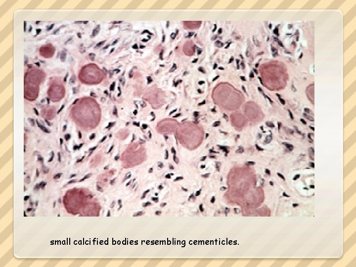 small calcified bodies resembling cementicles. 