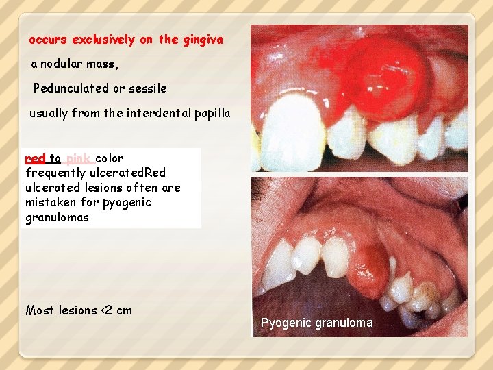 occurs exclusively on the gingiva a nodular mass, Pedunculated or sessile usually from the