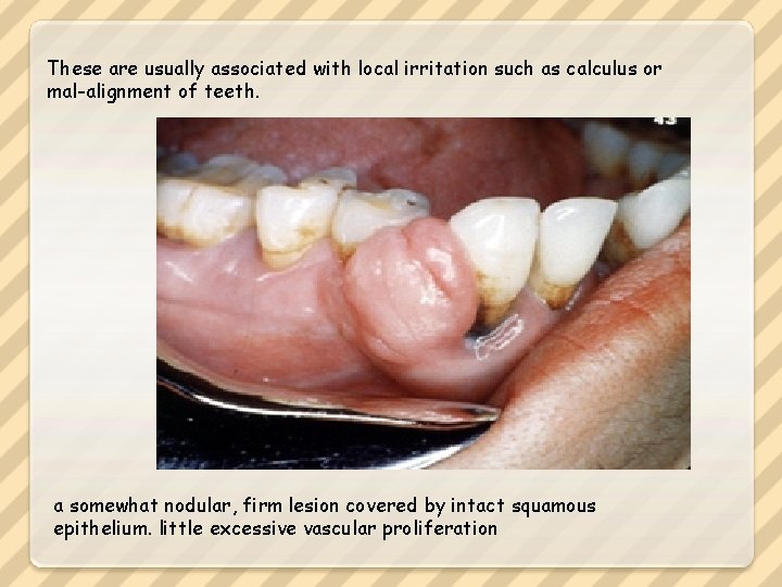 These are usually associated with local irritation such as calculus or mal-alignment of teeth.