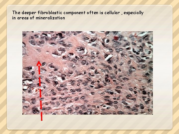 The deeper fibroblastic component often is cellular , especially in areas of mineralization 