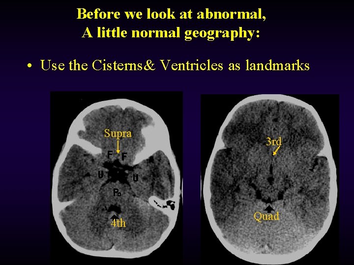 Before we look at abnormal, A little normal geography: • Use the Cisterns& Ventricles