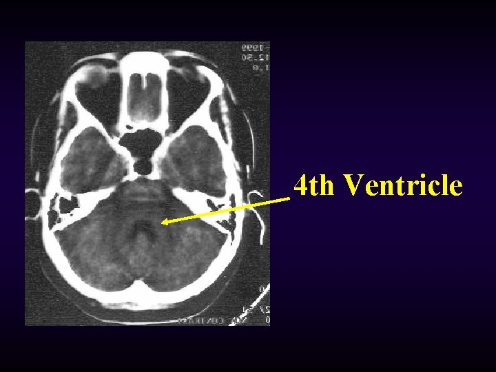4 th Ventricle 