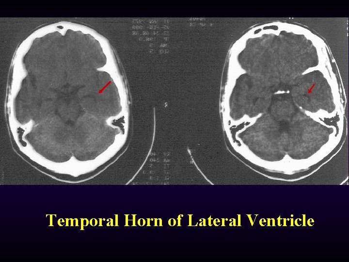 Temporal Horn of Lateral Ventricle 
