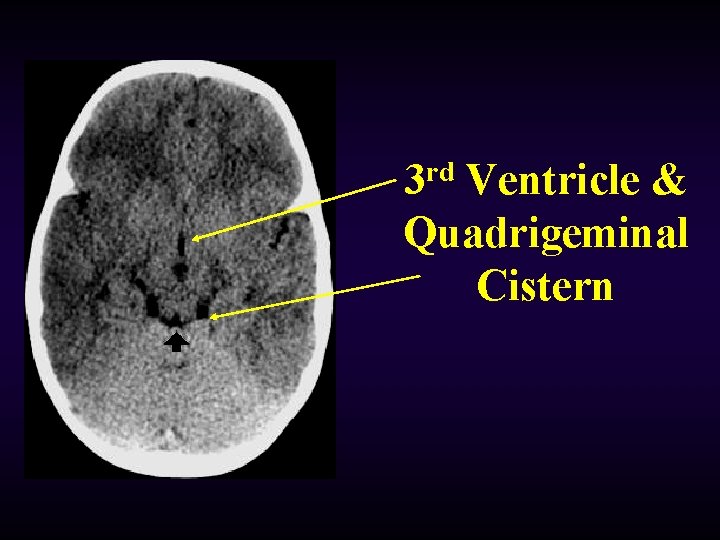 3 rd Ventricle & Quadrigeminal Cistern 