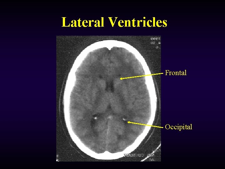 Lateral Ventricles Frontal Occipital 
