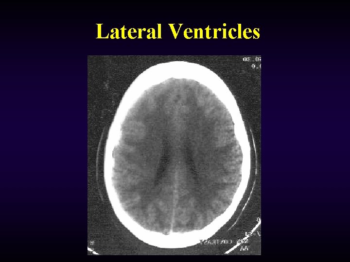 Lateral Ventricles 