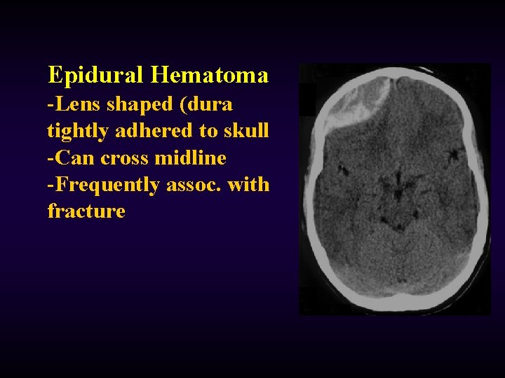 Epidural Hematoma -Lens shaped (dura tightly adhered to skull -Can cross midline -Frequently assoc.