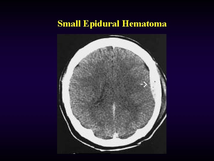 Small Epidural Hematoma 