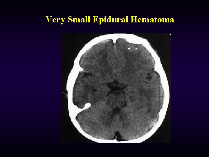 Very Small Epidural Hematoma 