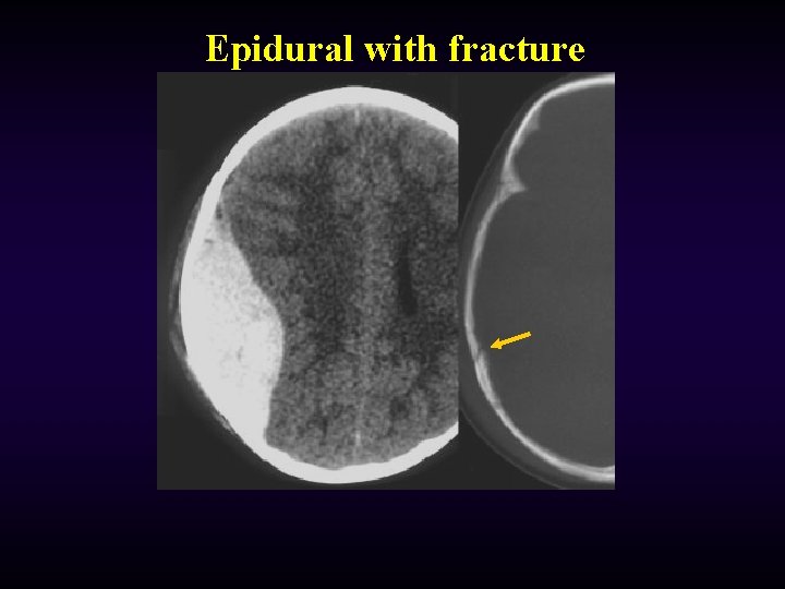 Epidural with fracture 