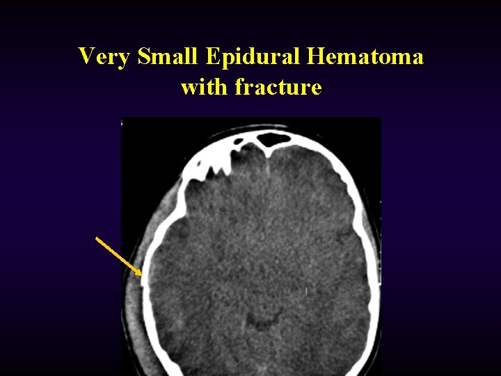 Very Small Epidural Hematoma with fracture 