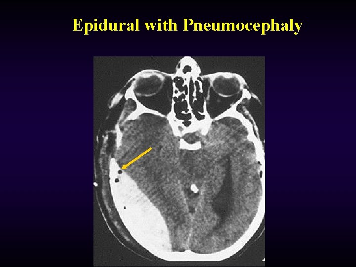 Epidural with Pneumocephaly 