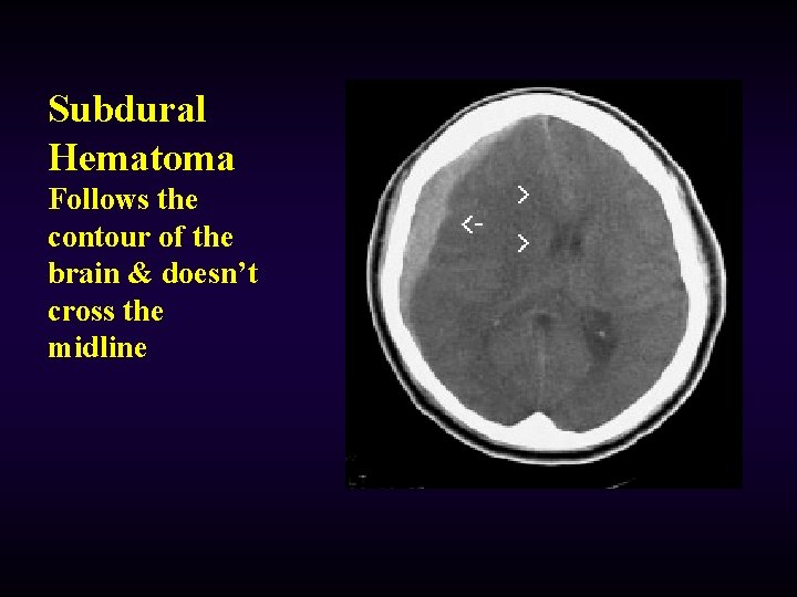 Subdural Hematoma Follows the contour of the brain & doesn’t cross the midline 