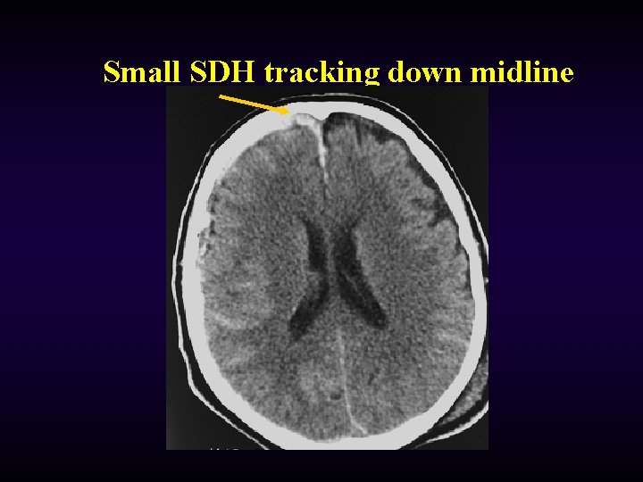 Small SDH tracking down midline 