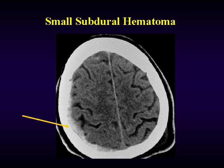 Small Subdural Hematoma 