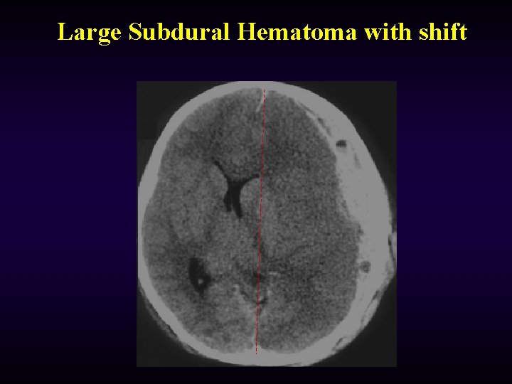 Large Subdural Hematoma with shift 
