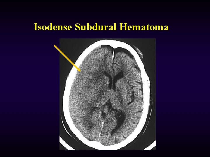 Isodense Subdural Hematoma 
