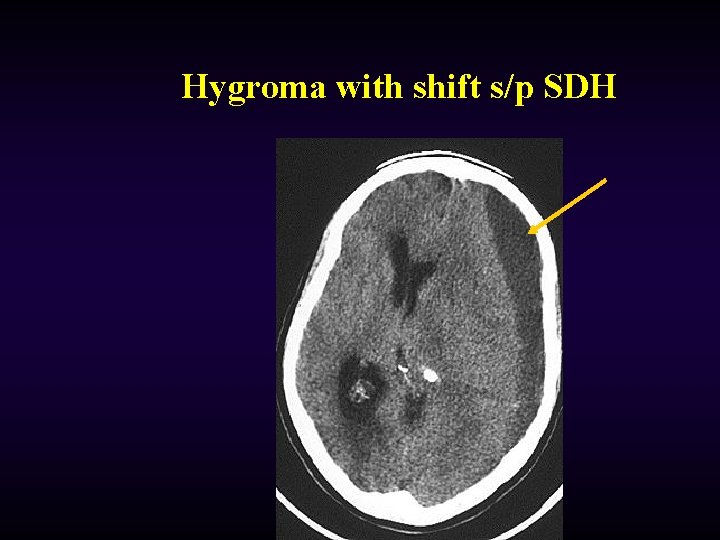 Hygroma with shift s/p SDH 