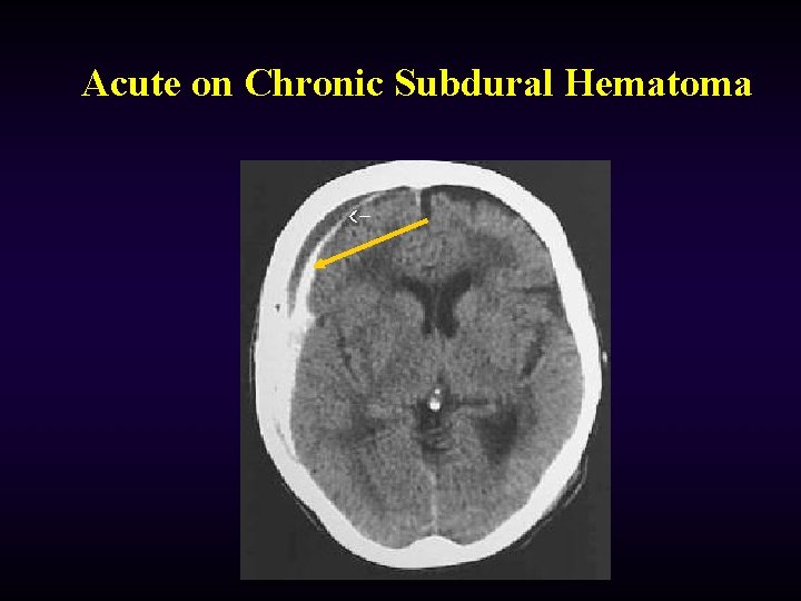 Acute on Chronic Subdural Hematoma 
