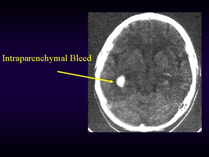 Intraparenchymal Bleed 