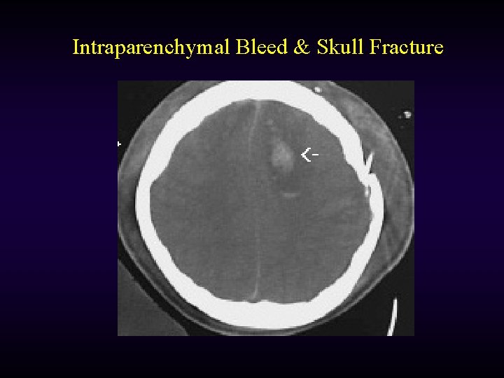Intraparenchymal Bleed & Skull Fracture 