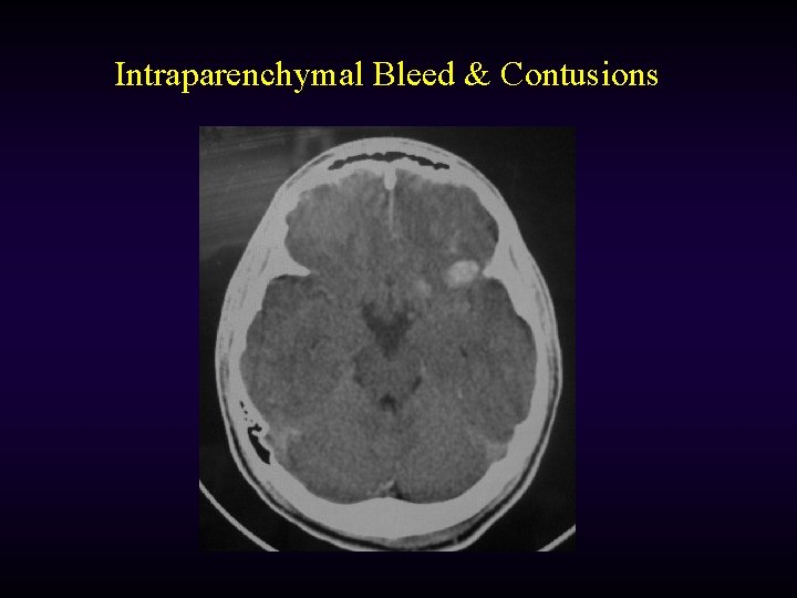 Intraparenchymal Bleed & Contusions 