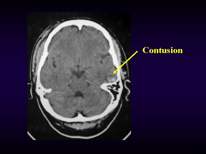 Contusion 