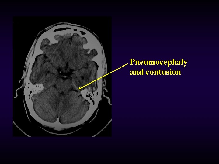 Pneumocephaly and contusion 