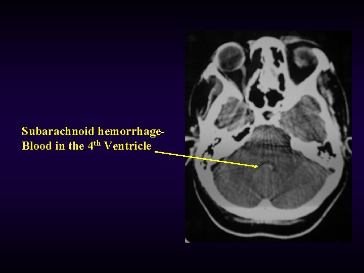 Subarachnoid hemorrhage. Blood in the 4 th Ventricle 