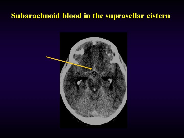 Subarachnoid blood in the suprasellar cistern 